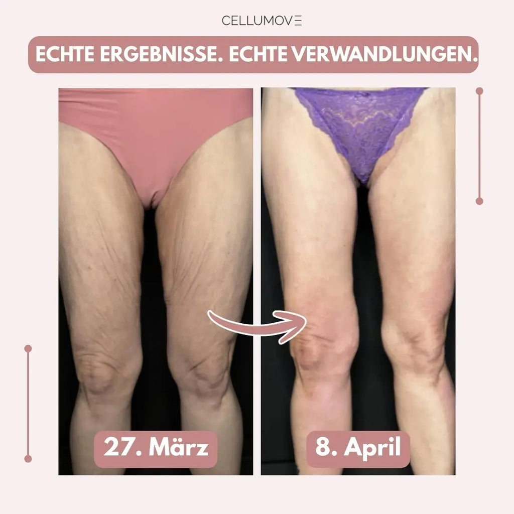Firmer, smoother legs in 14 days — for women who are tired of being held back by sagging skin
