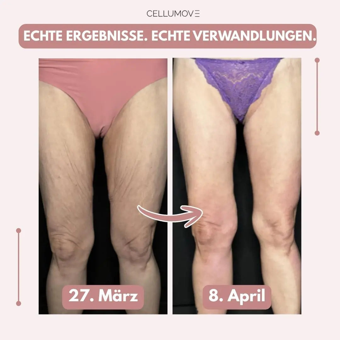 Firmer, smoother legs in 14 days — for women who are tired of being held back by sagging skin