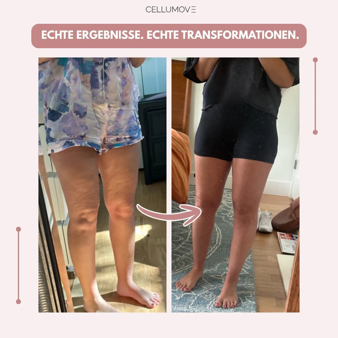 Cellumove 3D Legging – Verabschieden Sie sich auf natürliche Weise von den Schmerzen und Schwellungen des Lipödems