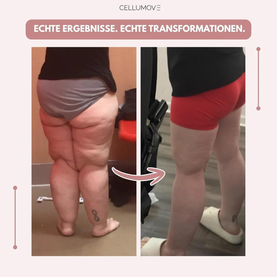 Cellumove 3D Legging – Verabschieden Sie sich auf natürliche Weise von den Schmerzen und Schwellungen des Lipödems