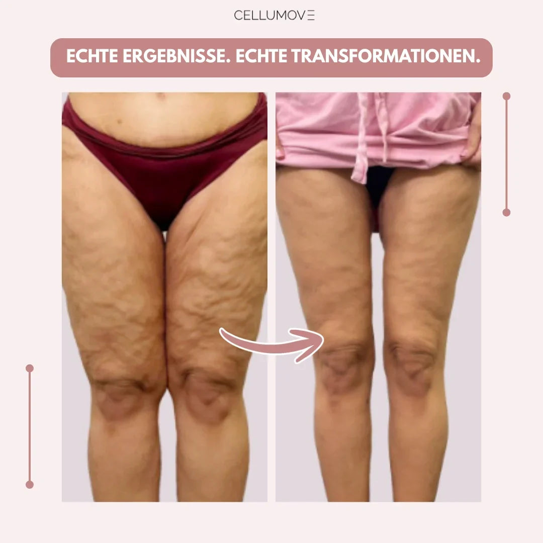 Cellumove 3D Legging – Verabschieden Sie sich auf natürliche Weise von den Schmerzen und Schwellungen des Lipödems