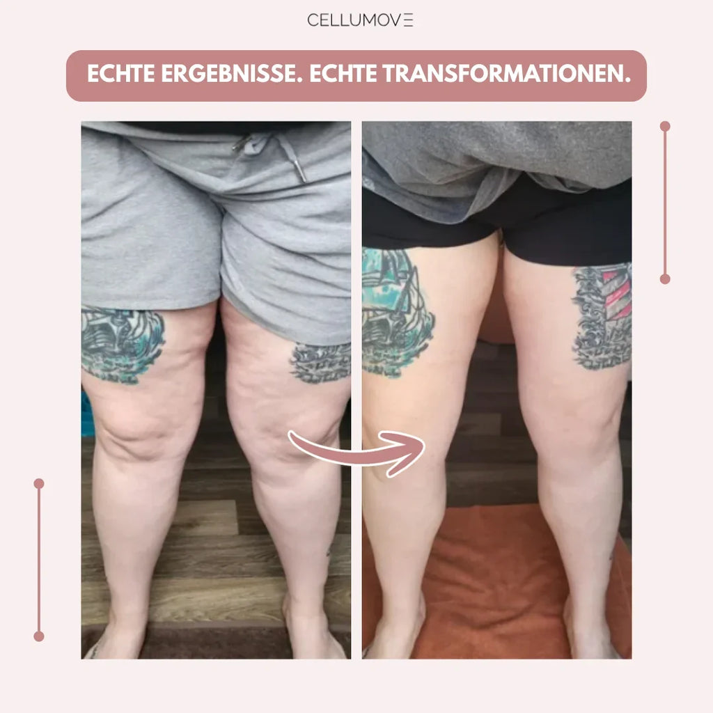 Cellumove 3D Legging – Verabschieden Sie sich auf natürliche Weise von den Schmerzen und Schwellungen des Lipödems